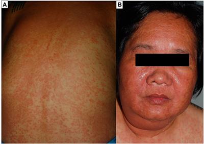 Frontiers | Drug-Induced Severe Cutaneous Adverse Reactions